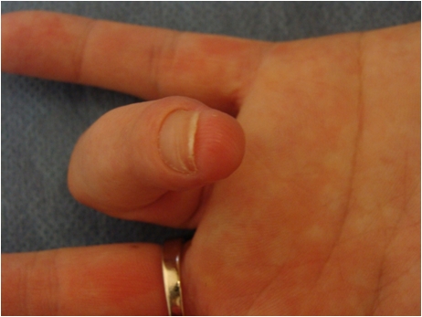 Extension of the finger after a traumatic tip amputation - after 6 months